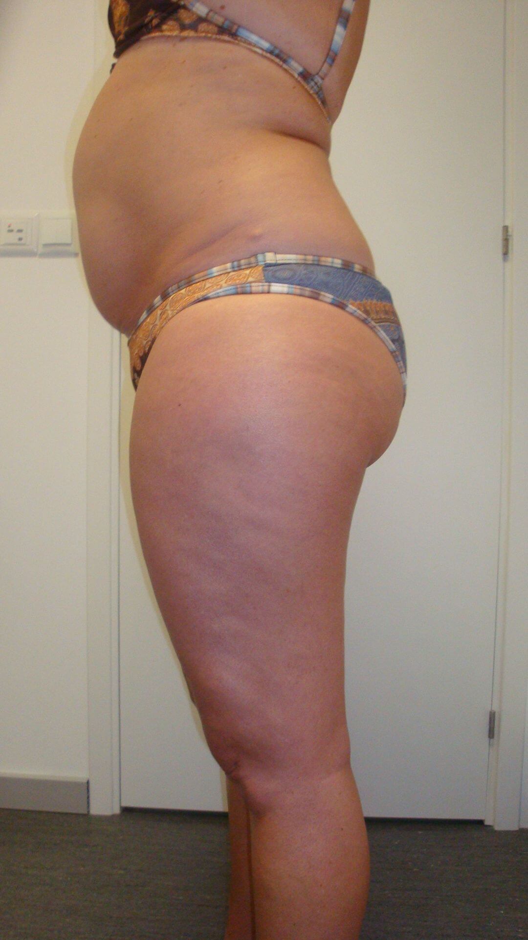 Antes do tratamento corporal